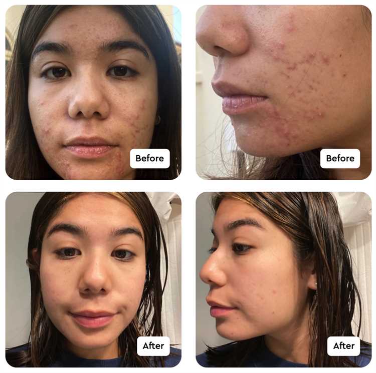 Buy Accutane Online for Effective Acne Treatment Buy accutane